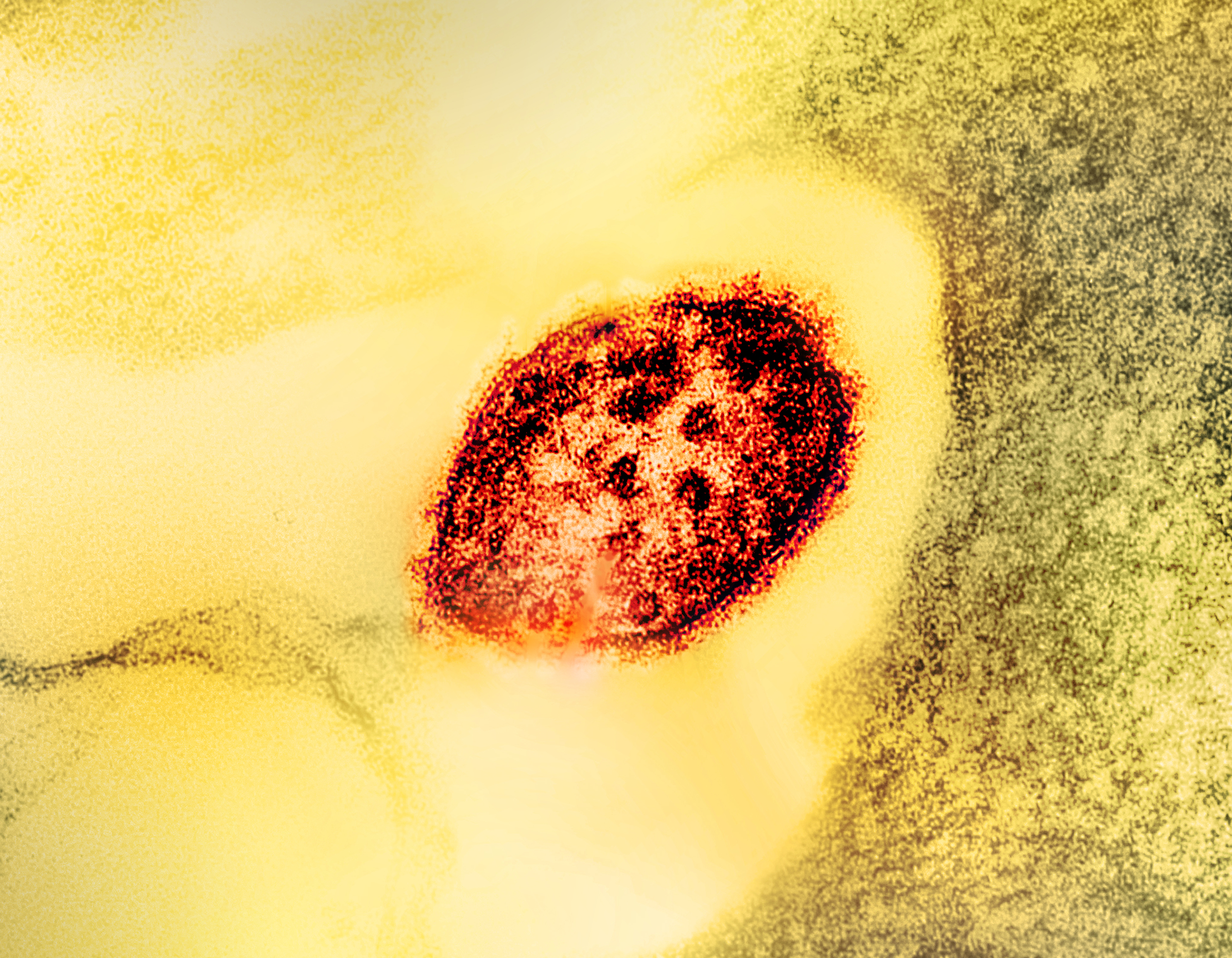Colorized transmission electron micrograph showing a measles virus particle